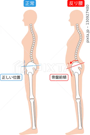 前かがみで痛い腰痛の特徴と見分け方