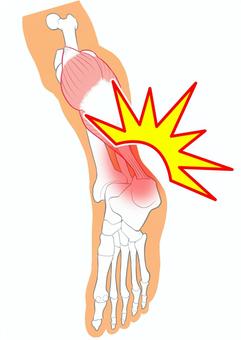 アキレス腱の上が痛いときに多い症状の特徴