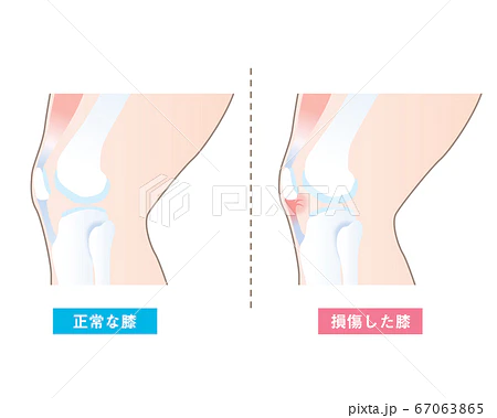 靭帯伸びるとは?損傷との違いをわかりやすく解説
