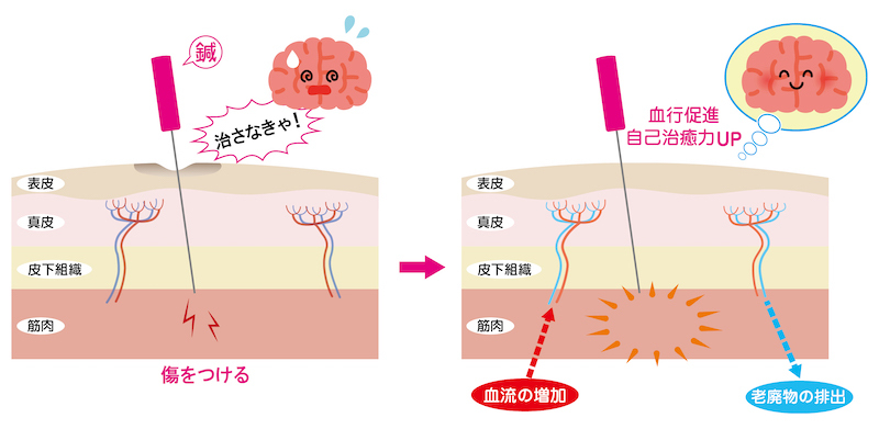 置き針で期待できる主な効果・作用
