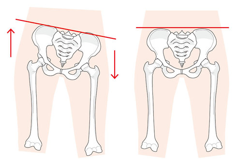 腰の冷えの主な原因②:骨盤の歪みや姿勢のクセ