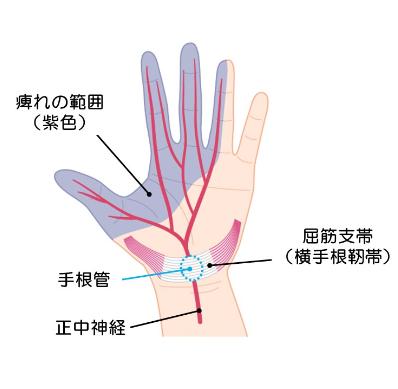 手のひらが痛くなる主な原因