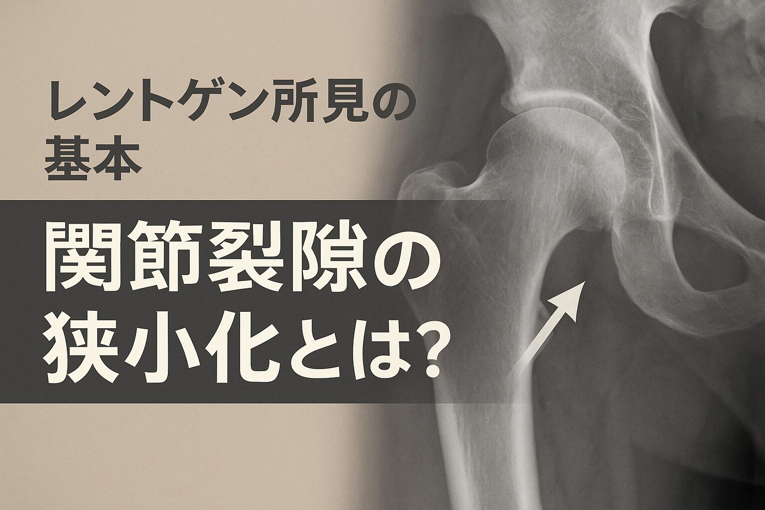 レントゲン所見の基本「関節裂隙の狭小化」とは？