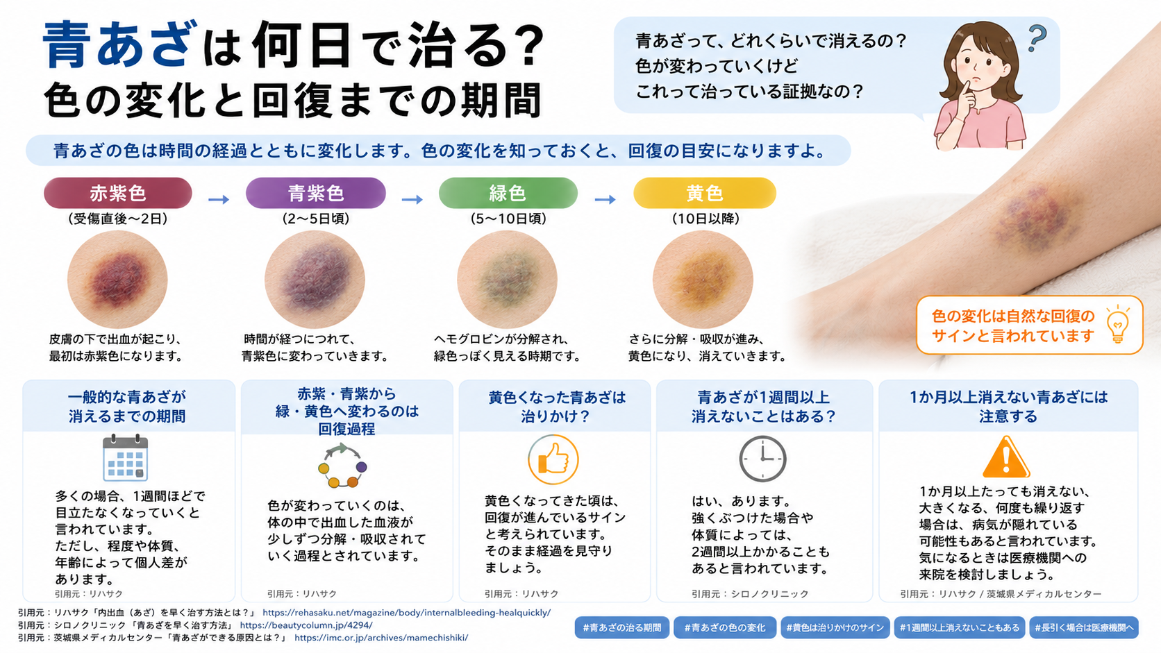 青あざは何日で治る?色の変化と回復までの期間