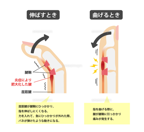寝起きだけ出るばね指が起こる原因と背景