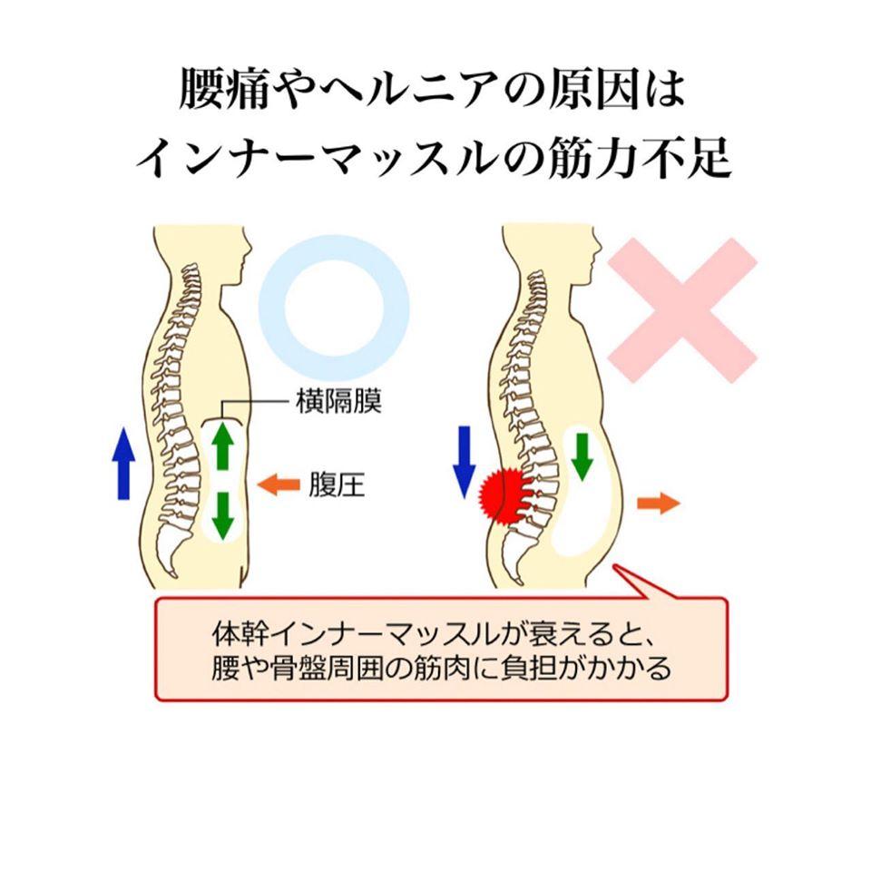 ヘルニアの主な原因|日常生活に潜むリスク