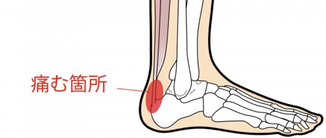 アキレス腱の上が痛い原因とは?