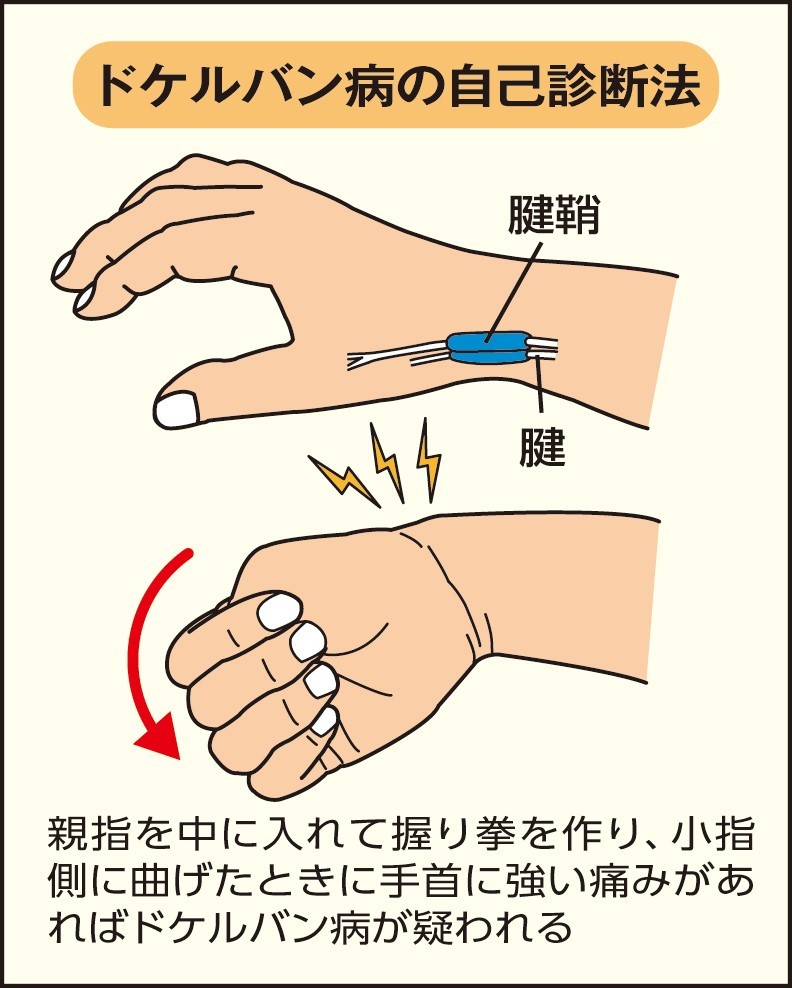 ドケルバンとは?症状と特徴