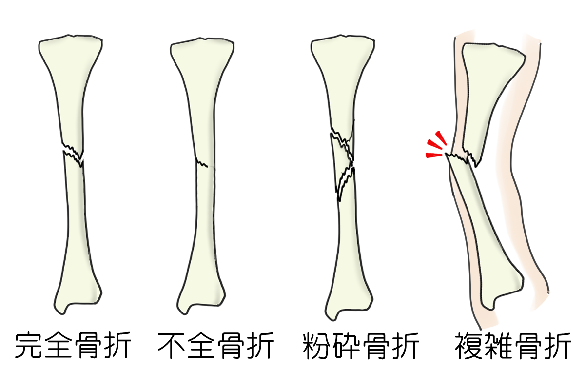 膝ヒビ(不全骨折)とは?症状と特徴