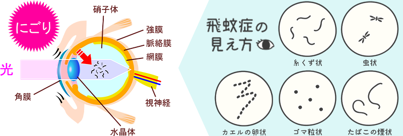 飛蚊症イメージ