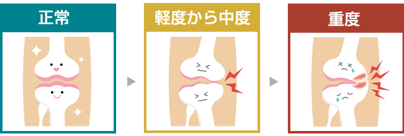 膝関節の骨がすり減るイメージ
