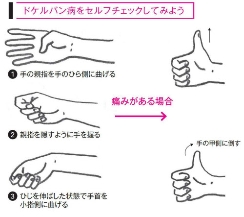 スマホ親指の痛みの症状チェック方法