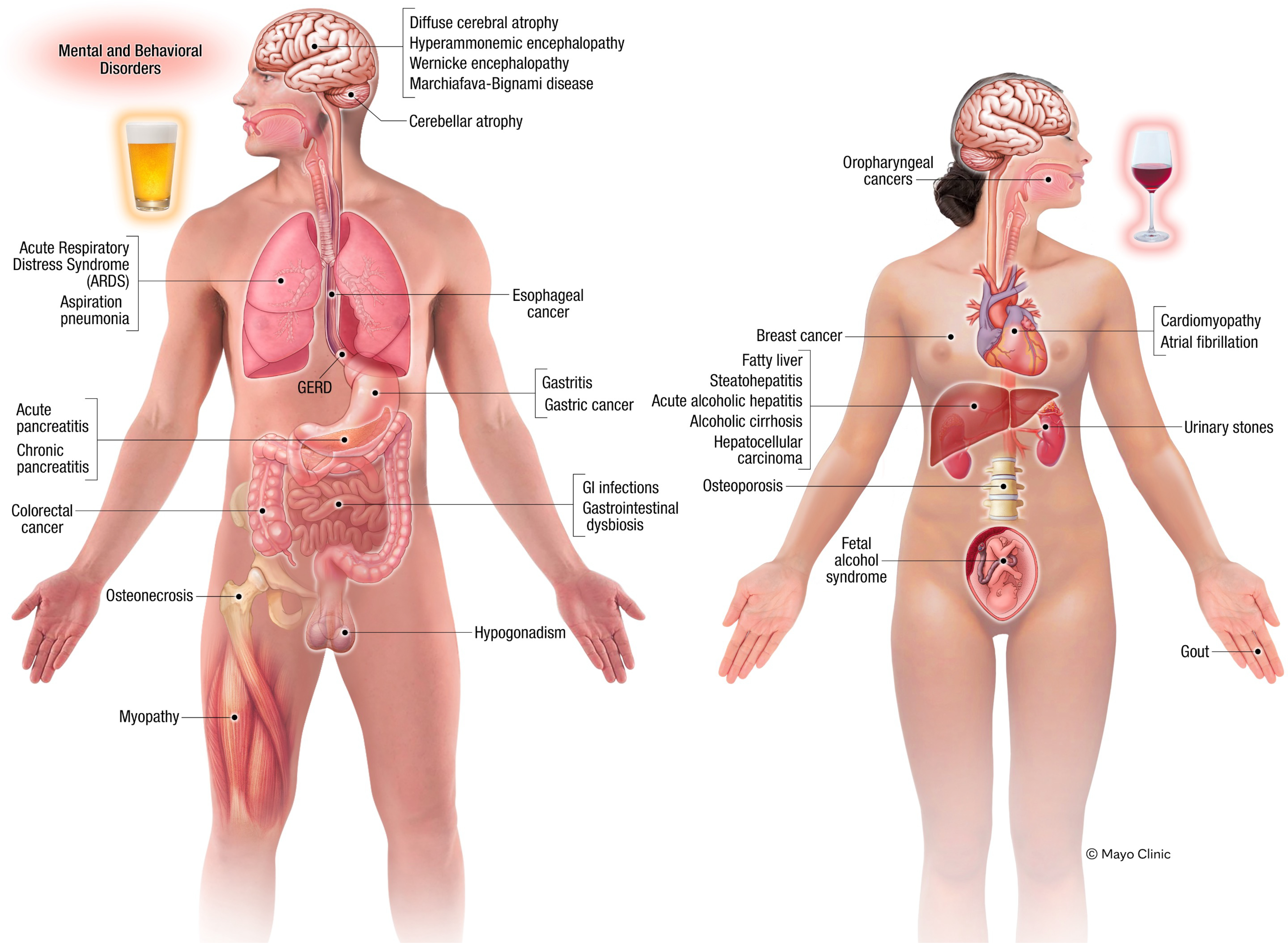 アルコール筋症とは?寝れない原因になる筋肉障害