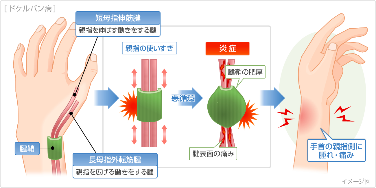 ドケルバンの原因と悪化する理由