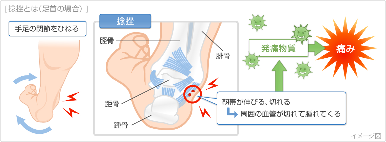 捻挫 歩けるけど痛い 知恵袋|痛みの原因とメカニズムを整理