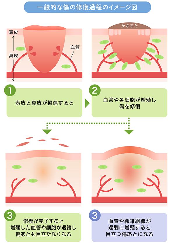 打ち身で腫れる原因とは?仕組みをわかりやすく解説