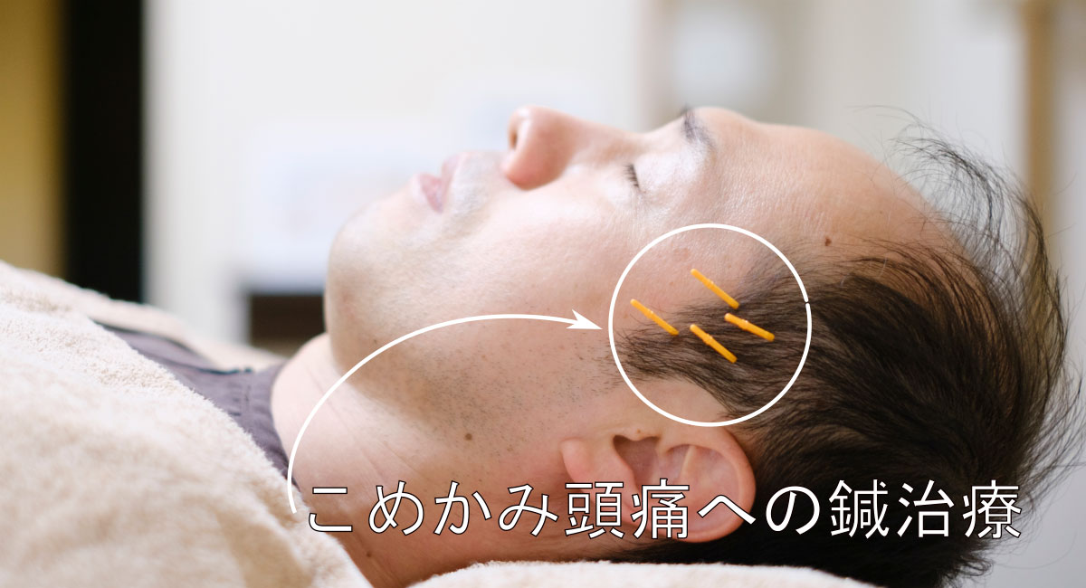 頭痛の種類別:鍼灸の効果と適応