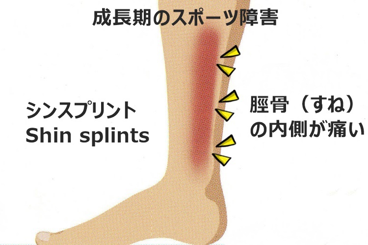すねが痛い 前側の主な原因とは