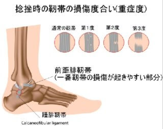 捻挫 歩けるけど痛い 知恵袋|来院の判断基準とチェックリスト