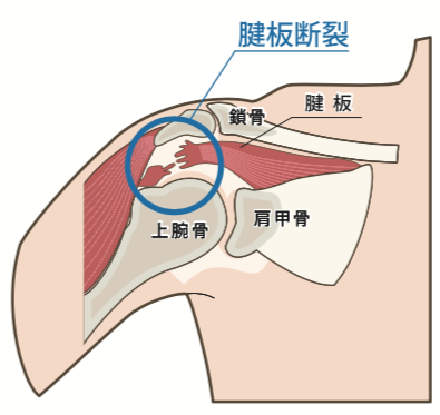 右肩の痛みと関係する可能性がある主ながん