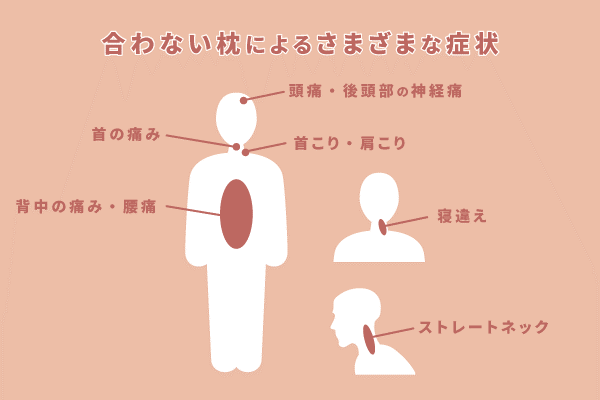 寝違え(首痛い)の基本理解