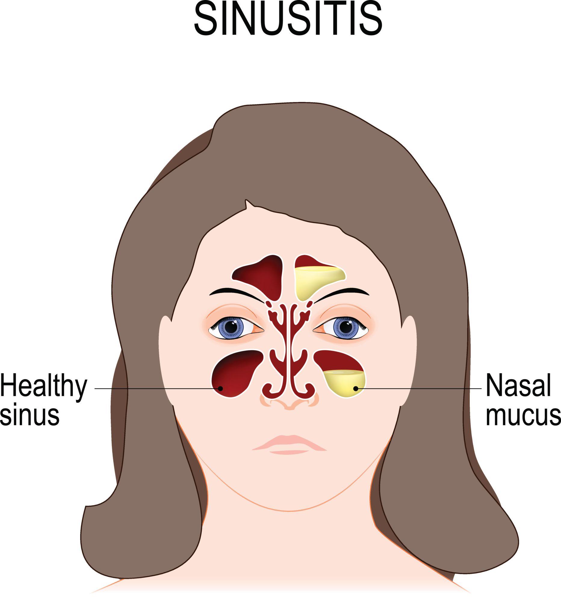 副鼻腔や鼻の圧力変化と頭痛
