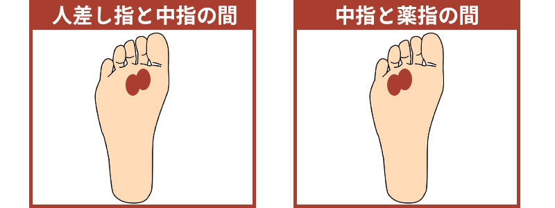 モートン病イメージ