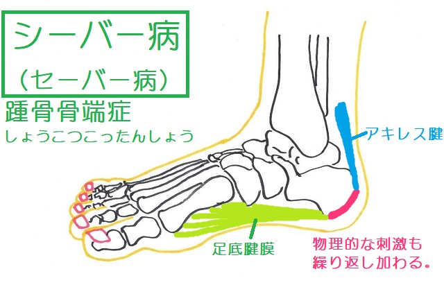 シーバー病(踵骨骨端症)の典型的な症状
