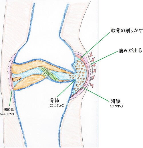 膝ヒビとよく混同される状態(骨挫傷との違い)