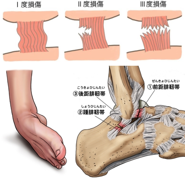 捻挫とは?早く治すために知っておきたい基礎知識