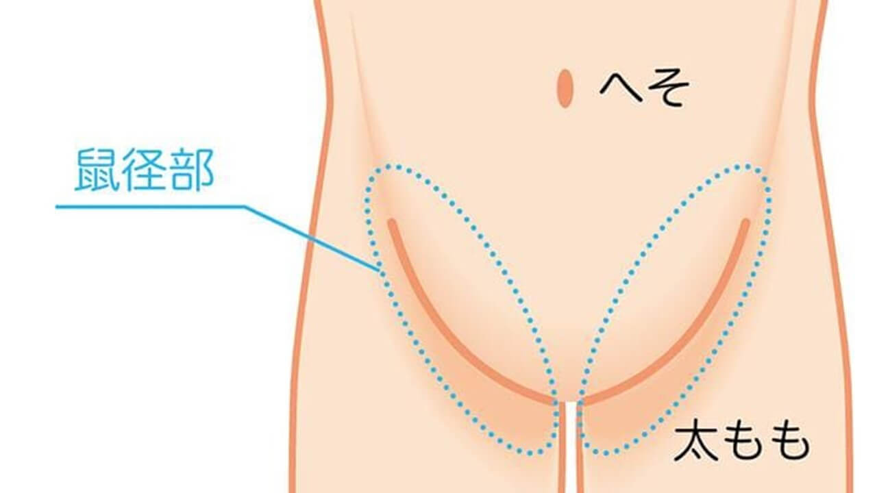 足の付け根(鼠径部)の「腫れ」とは?